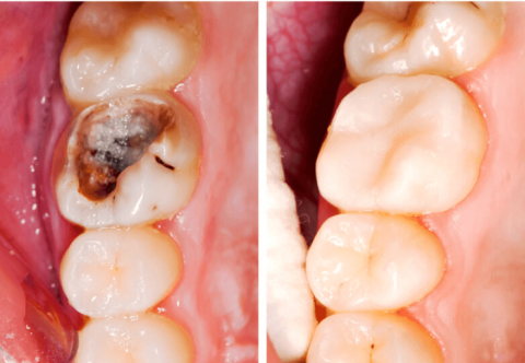 Trám răng có đau không, cách chăm sóc sau khi trám răng